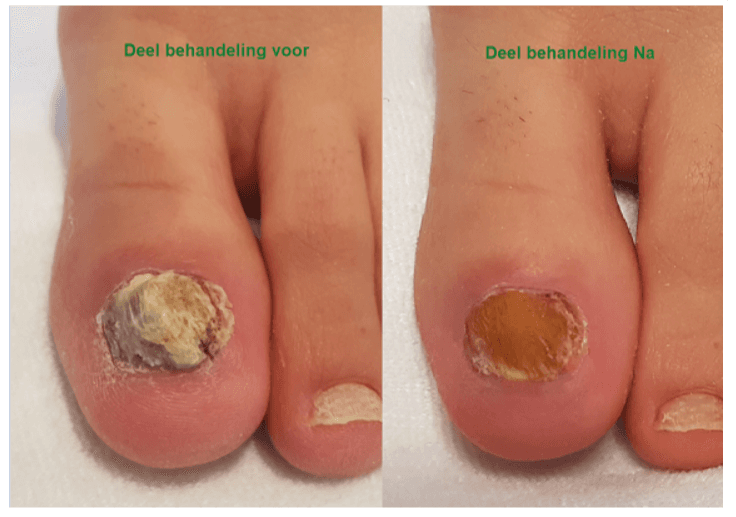 Deel behandeling
