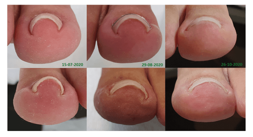 Nagelbeugel