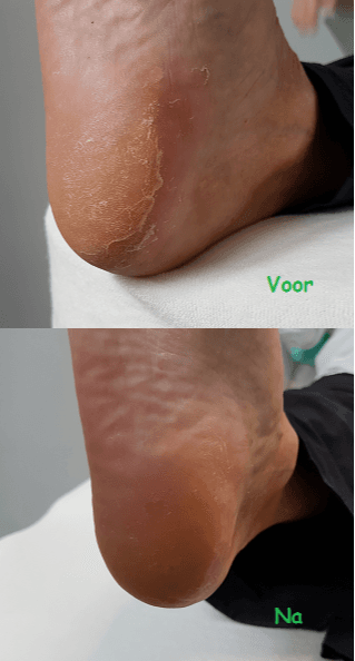 Voor en Na behandeling